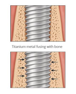 ¿Osseointegration: Por qué el Osteoinductor Cerámico es la Estrella en Crecimiento de Huesos?